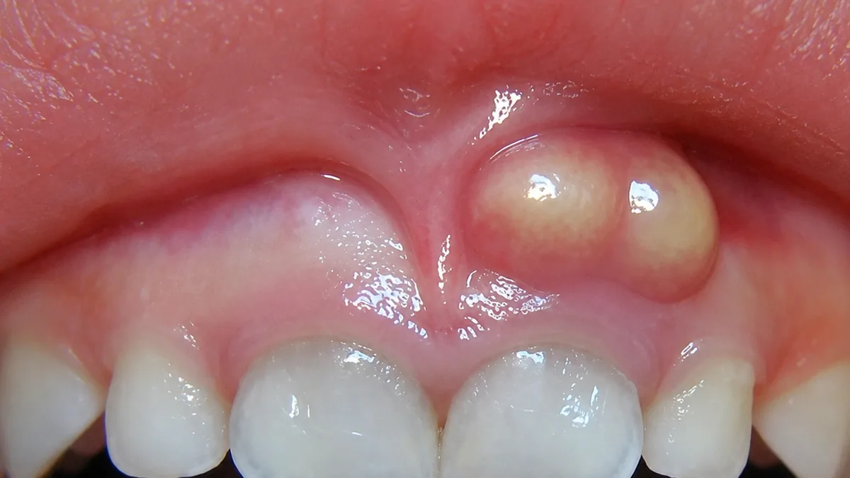 A periodontal abscess swelling breaking through the gumline